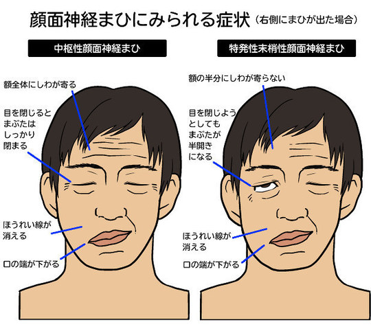 顔面神経麻痺の特徴